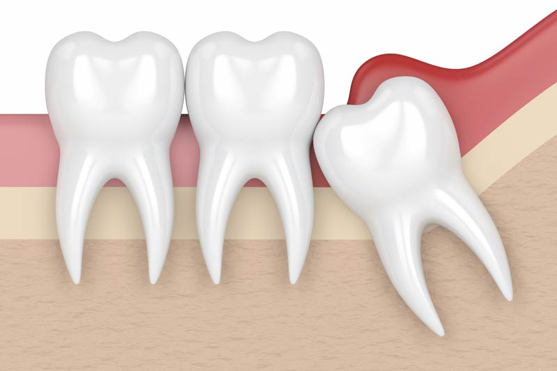 Wisdom Tooth Removal in White Lake